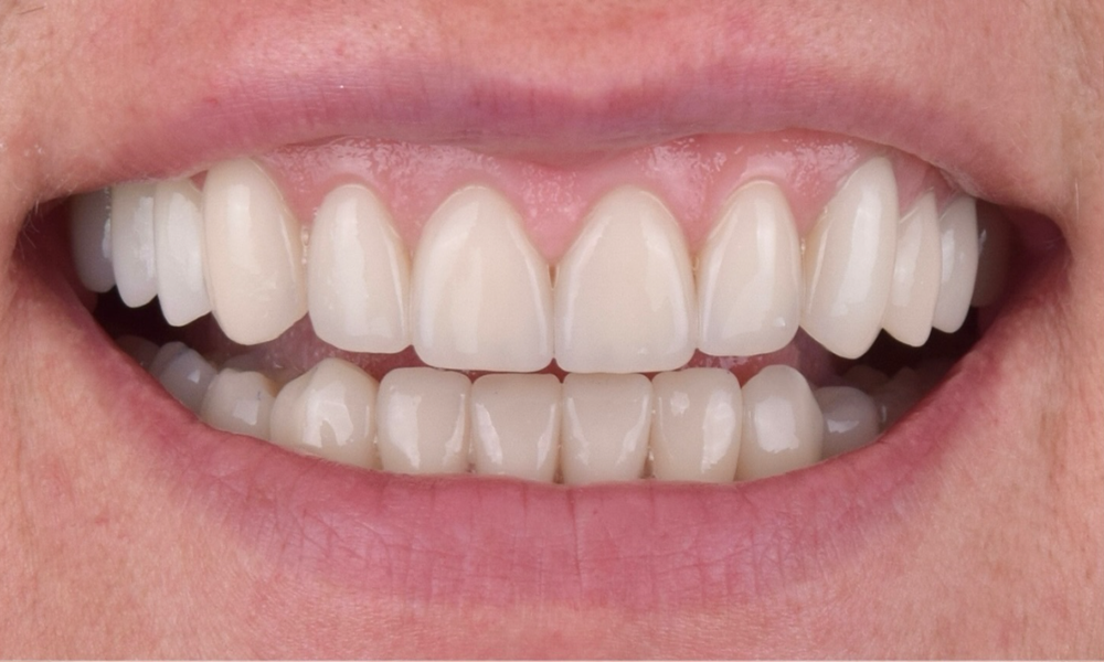 Зуби пацієнта після лікування