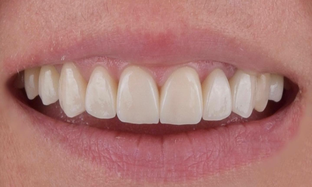 Естетика посмішки — після процедури