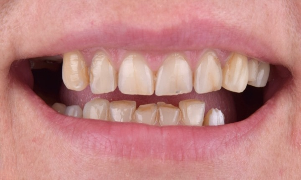 Зуби пацієнта до лікування