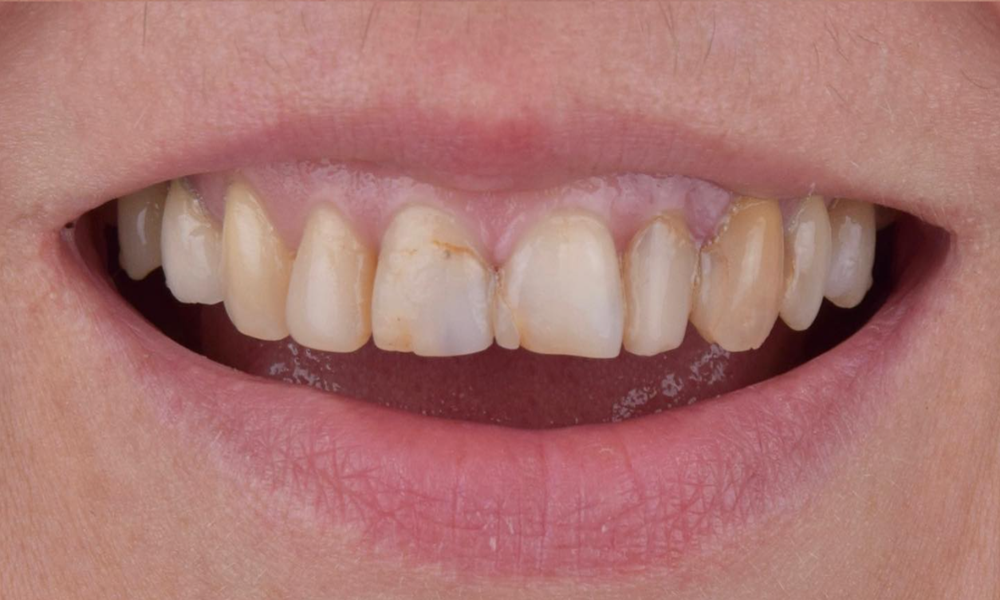 Естетика посмішки — до процедури